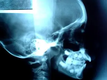 x-ray of a brain injury