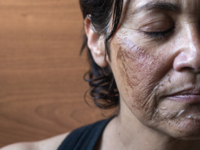 Close-up of a person with visible facial burn scars and permanent disfigurement, illustrating the lasting physical and emotional effects of a catastrophic injury.